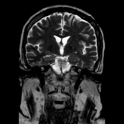File:Neurofibromatosis type 2 (Radiopaedia 8713-9518 Coronal T2 12).jpg