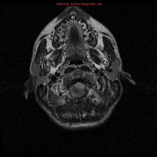 File:Neurofibromatosis type 2 (Radiopaedia 8953-9730 Axial FLAIR 4).jpg