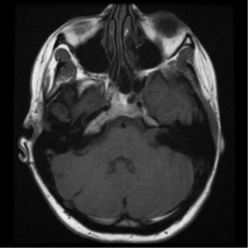 File:Neurofibromatosis type 2 - bilateral acoustic neuromata (Radiopaedia 40060-42566 Axial T1 7).png