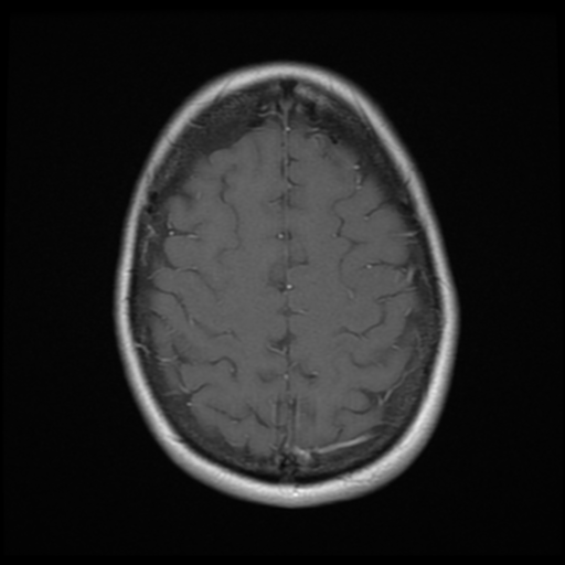 File:Neurofibromatosis type 2 - bilateral acoustic neuromata (Radiopaedia 40060-42566 Axial T1 C+ 17).png
