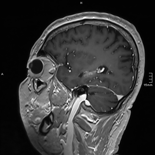 Neurosarcoidosis - involvement of the mesial temporal lobes (Radiopaedia 67429-76820 Sagittal T1 C+ 120).jpg