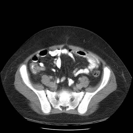 File:Non-Hodgkin lymphoma involving pelvis (Radiopaedia 21281-21197 A 47).jpg