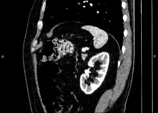 Non-syndromic pancreatic endocrine tumor (Radiopaedia 86958-103178 E 78).jpg
