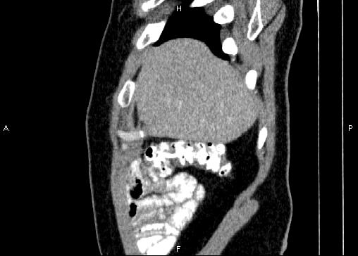 Non-syndromic pancreatic endocrine tumor (Radiopaedia 86958-103178 E 9).jpg