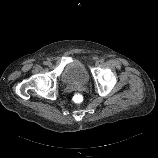 File:Non Hodgkin lymphoma in a patient with ankylosing spondylitis (Radiopaedia 84323-99624 Axial non-contrast 62).jpg