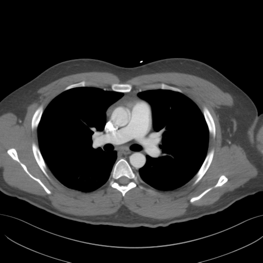 File:Normal CTA thorax (non ECG gated) (Radiopaedia 41750-44704 A 43).png