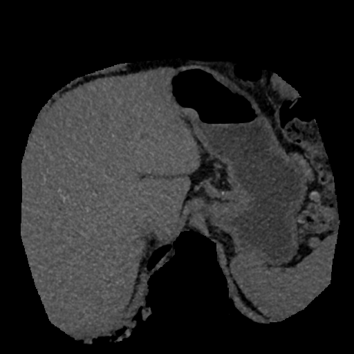 File:Normal CT intravenous cholangiogram (Radiopaedia 38199-40208 Axial IVC (MIP) 69).png