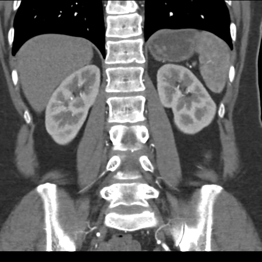 File:Normal CT renal artery angiogram (Radiopaedia 38727-40889 B 54).png