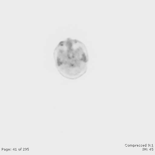 File:Normal F-18 FDG PET-CT (Radiopaedia 77382-89510 C 41).jpg