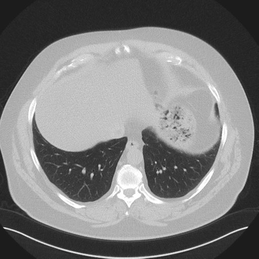 Normal HRCT (Radiopaedia 40797-43458 Axial lung window 44).png
