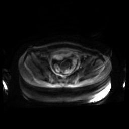 Normal MRI abdomen in pregnancy (Radiopaedia 88001-104541 Axial DWI 50).jpg