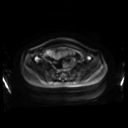 Normal MRI abdomen in pregnancy (Radiopaedia 88001-104541 Axial DWI 54).jpg