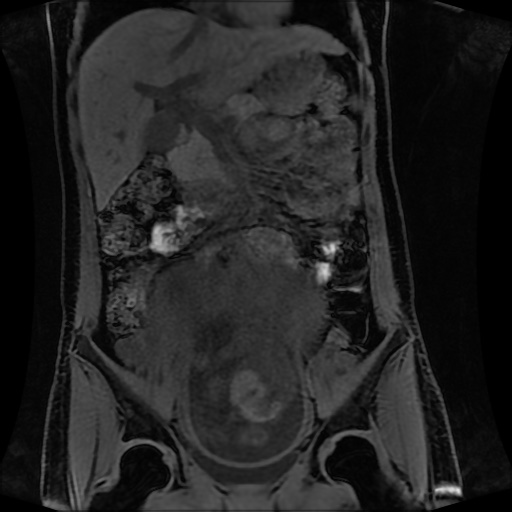 Normal MRI abdomen in pregnancy (Radiopaedia 88001-104541 M 66).jpg