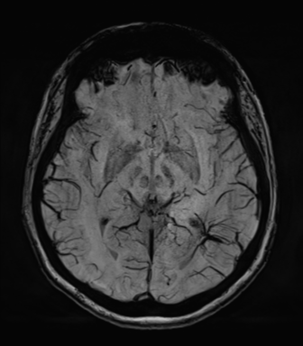 Normal MRI internal auditory canal (Radiopaedia 41613-44525 Axial SWI MIP 37).png