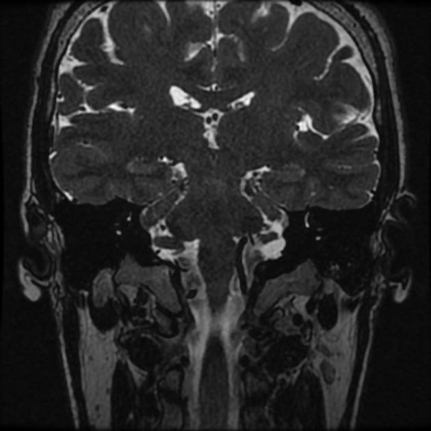 Normal MRI petrous (Radiopaedia 91317-108949 Coronal T2 61).jpg