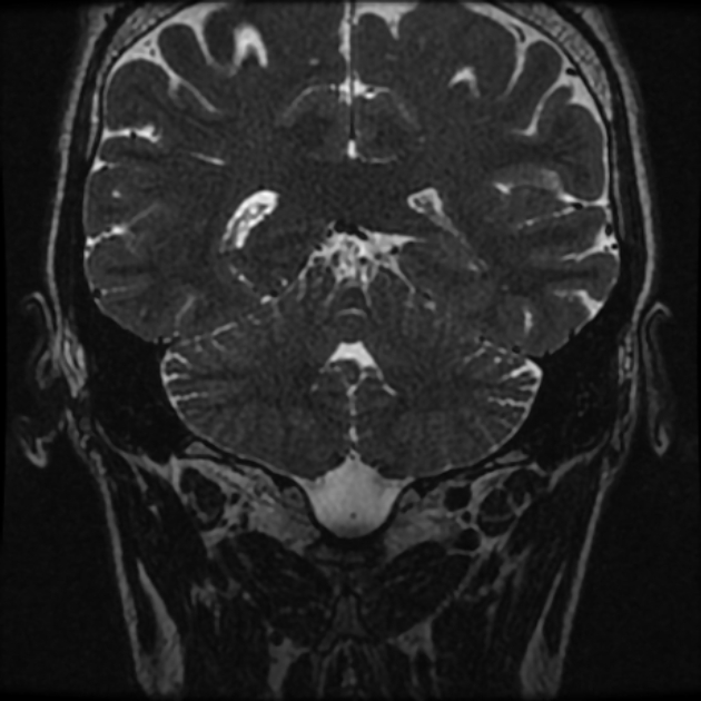 Normal MRI petrous (Radiopaedia 91317-108949 Coronal T2 90).jpg
