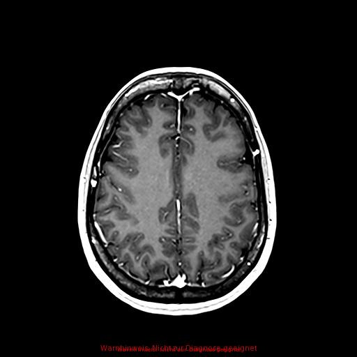 Normal adult brain MRI (non-enhanced and contrast-enhanced) (Radiopaedia 75262-86379 Axial T1 C+ 133).jpg