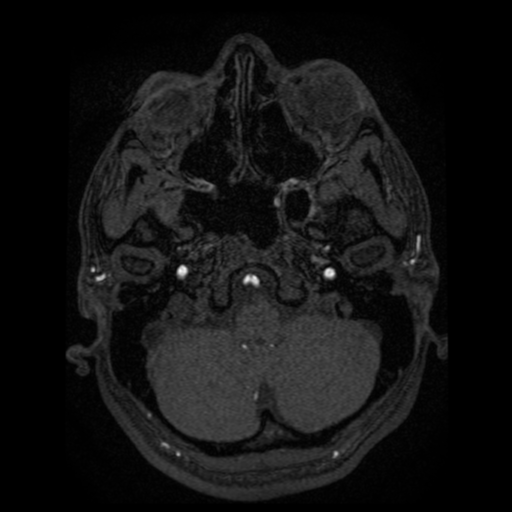 Normal brain MRA (Radiopaedia 41046-43793 Axial MRA 101).png