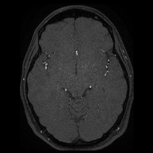 Normal brain MRA (Radiopaedia 41046-43793 Axial MRA 40).png