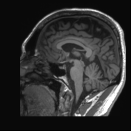 Normal brain MRI (non-focal epilepsy protocol) (Radiopaedia 53917-60040 Sagittal T1 32).png