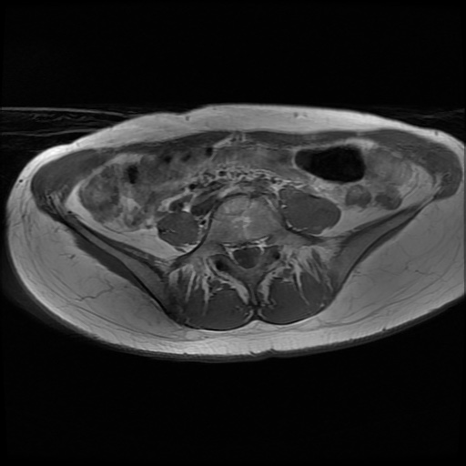 File:Normal female pelvis MRI (retroverted uterus) (Radiopaedia 61832-69933 Axial T1 3).jpg
