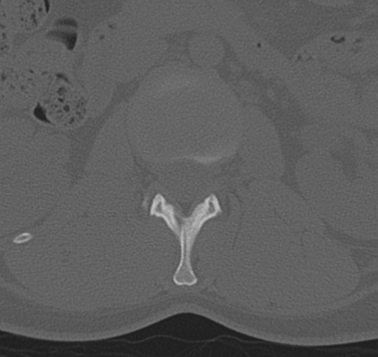 File:Normal lumbar spine CT (Radiopaedia 46533-50986 Axial bone window 17).png
