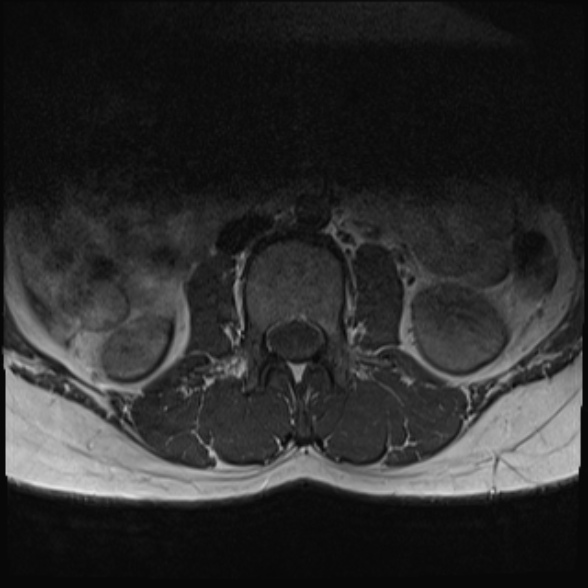 File:Normal lumbar spine MRI- 3 T (Radiopaedia 53280-59250 Axial 2).jpg