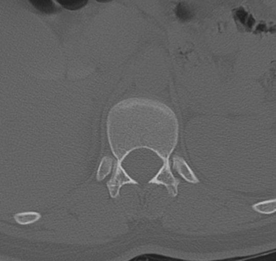 File:Normal lumbosacral CT (Radiopaedia 37923-39867 Axial bone window 22).png