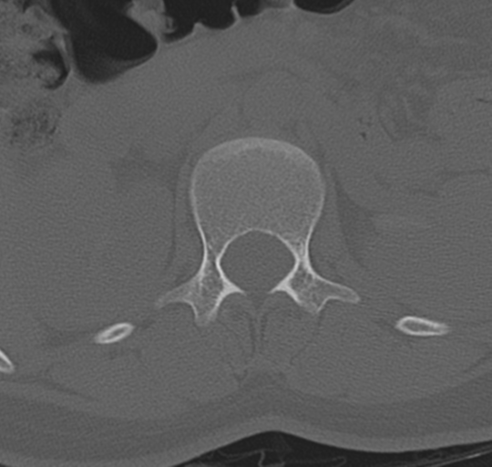 File:Normal lumbosacral CT (Radiopaedia 37923-39867 Axial bone window 31).png