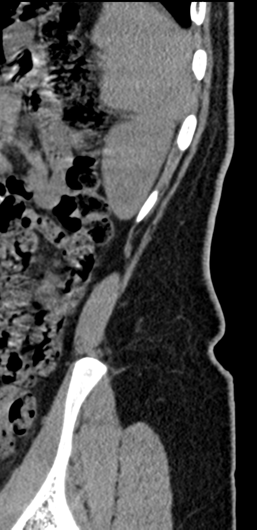 Normal lumbosacral CT (Radiopaedia 37923-39867 E 2).png