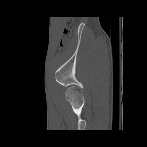 Normal pelvis (Radiopaedia 51473-57238 Sagittal bone window 28).jpg