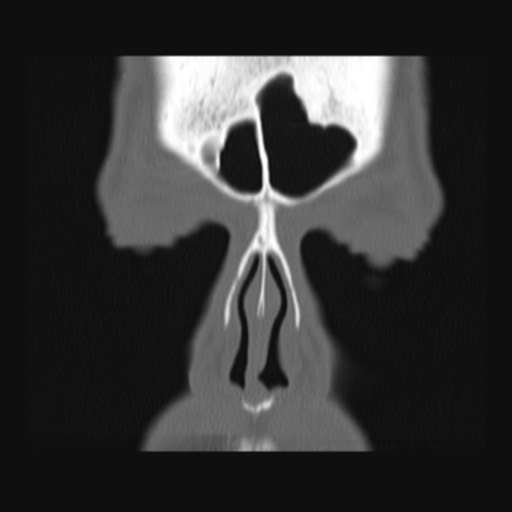 Normal sinus CT (annotated) (Radiopaedia 78917-91810 Coronal bone window 14).jpg