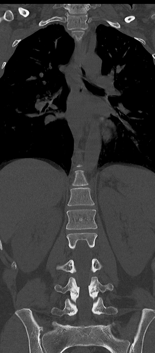 Normal thoracolumbar spine (Radiopaedia 43822-47309 Coronal bone window 46).png