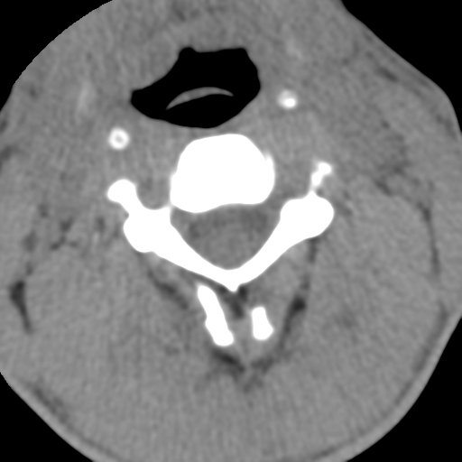 Normal trauma cervical spine (Radiopaedia 41017-43760 Axial non-contrast 26).png