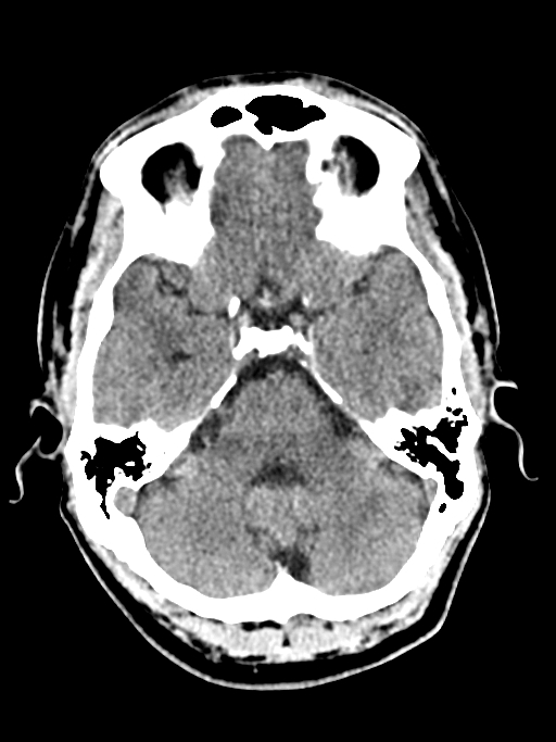 Normal trauma protocol brain and C-spine CT (Radiopaedia 83302-97709 Axial non-contrast 52).jpg