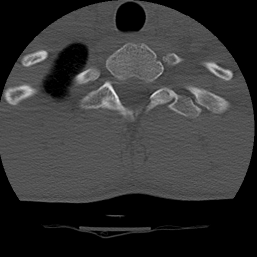 Normal trauma spine imaging (age 16) (Radiopaedia 45335-49358 Axial bone window 75).jpg