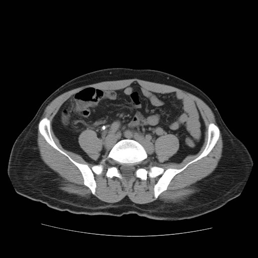 File:Obstructed kidney with perinephric urinoma (Radiopaedia 26889-27067 Axial non-contrast 29).jpg