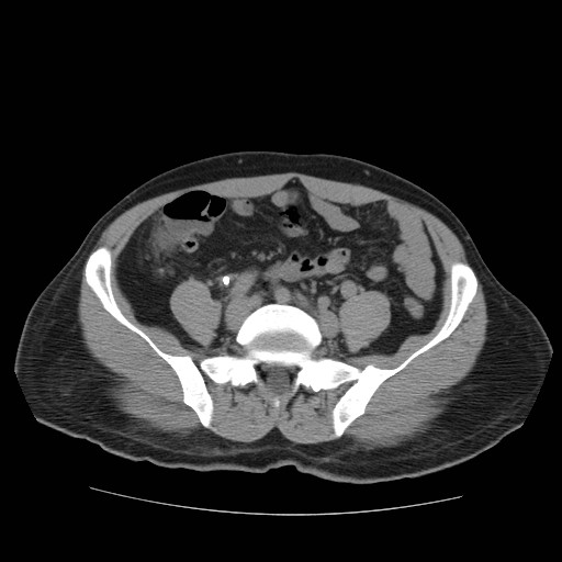 File:Obstructed kidney with perinephric urinoma (Radiopaedia 26889-27067 Axial non-contrast 30).jpg