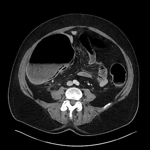 Obstructing sigmoid adenocarcinoma (Radiopaedia 58465-65619 A 102).jpg
