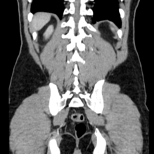 File:Obstructing ureteric calculus (Radiopaedia 18615-18514 C 64).jpg