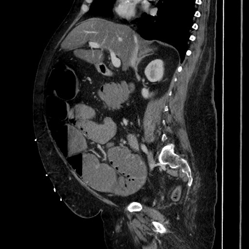 Obstructive colonic diverticular stricture (Radiopaedia 81085-94675 C 105).jpg