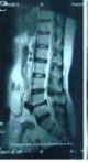 MRI of the lumbar spine, intervertebral disc degeneration