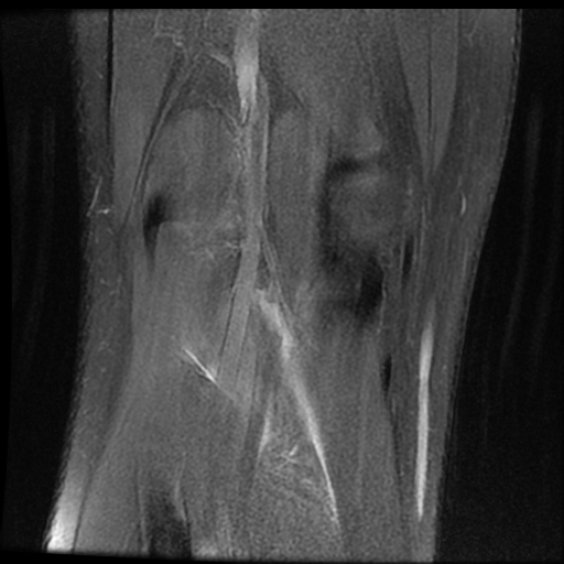 File:ACL acute full thickness tear - deep lateral femoral sulcus sign (Radiopaedia 38594-40740 Coronal PD fat sat 18).jpg