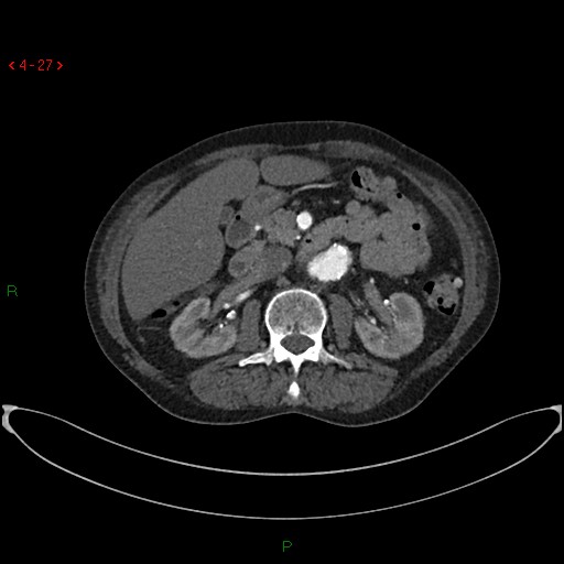 File:Abdominal aortic aneurysm (Radiopaedia 16155-15834 Axial C+ arterial phase 7).jpg
