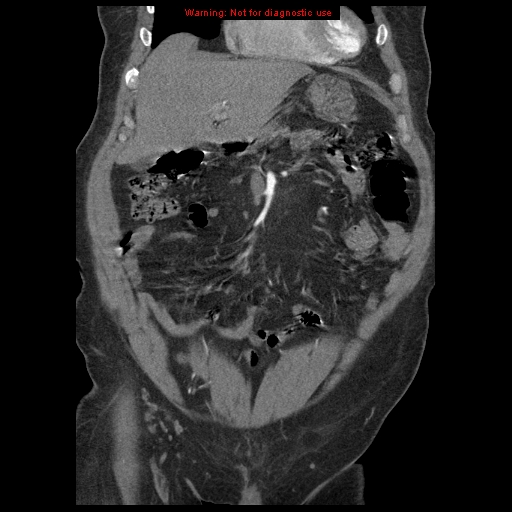 Abdominal aortic aneurysm (Radiopaedia 8190-9038 Coronal C+ arterial phase 33).jpg
