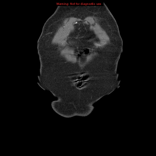 File:Abdominal aortic aneurysm (Radiopaedia 8190-9038 Coronal C+ arterial phase 5).jpg
