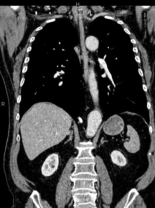Abdominal aortic aneurysm (Radiopaedia 83094-97462 Coronal renal cortical phase 59).jpg