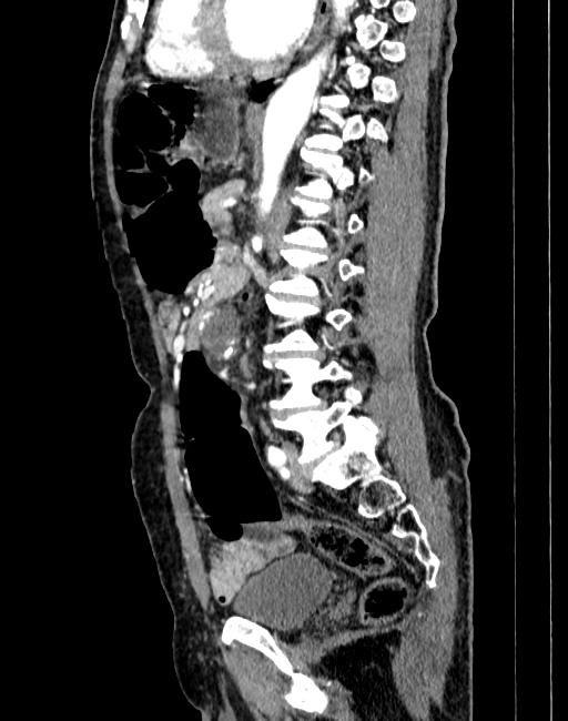 Abdominal aortic aneurysm (Radiopaedia 83581-98689 Sagittal C+ arterial phase 61).jpg