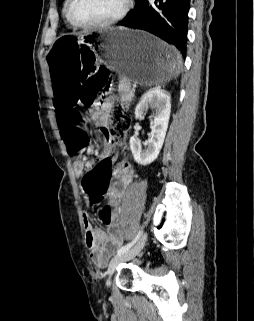 Abdominal aortic aneurysm (Radiopaedia 83581-98689 Sagittal C+ portal venous phase 92).jpg