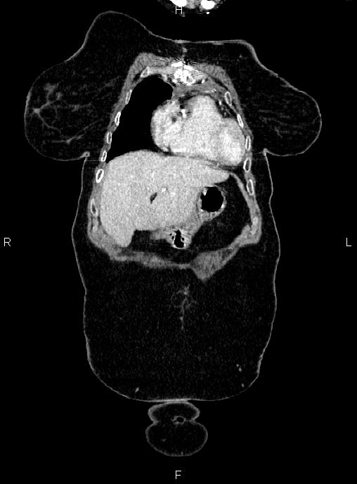 Abdominal aortic aneurysm (Radiopaedia 85063-100606 Coronal C+ arterial phase 2).jpg